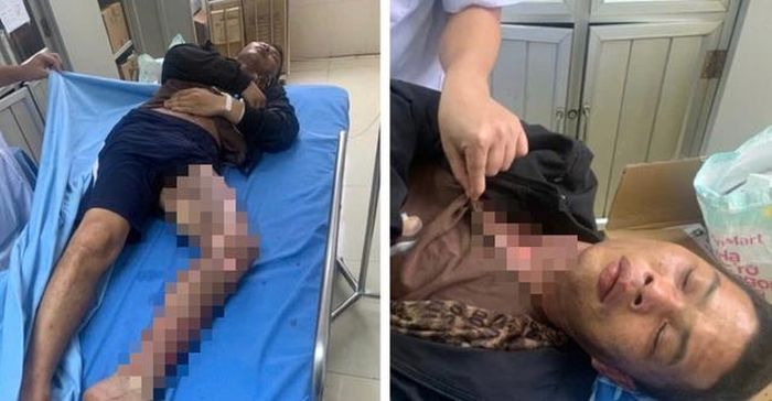 Leo trạm biến áp cắt trộm dây điện, hai người bị điện giật bỏng nặng